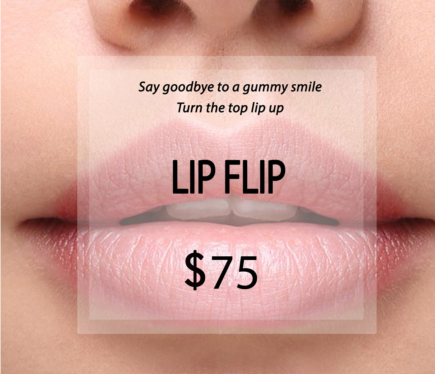 TOX: Lip Flip