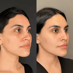 Hydrafacial glow before and after result.
