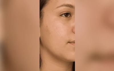 Hydrafacial Glow after